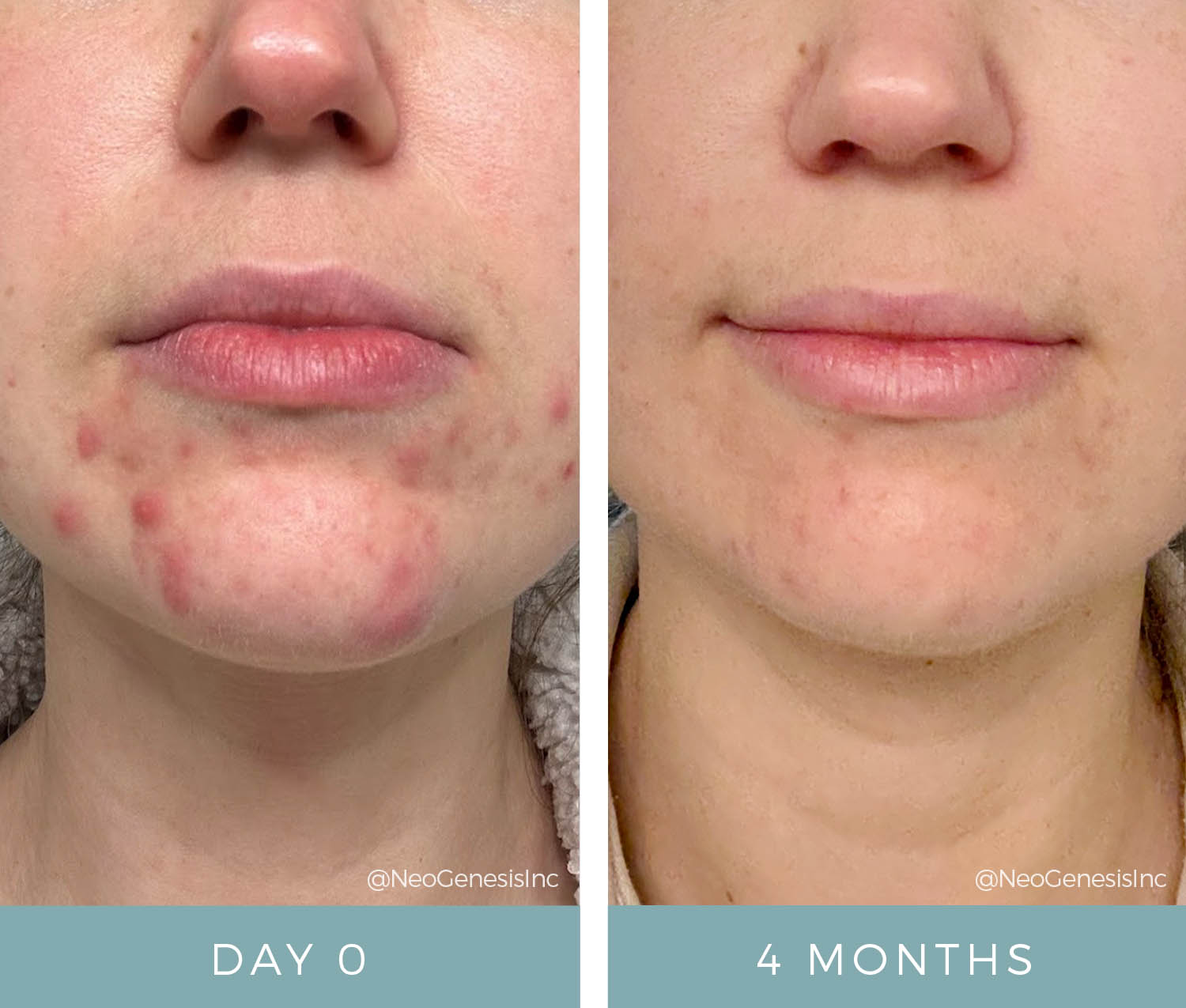 NeoGenesis skin barrier before and after – Day 0 and 4 months